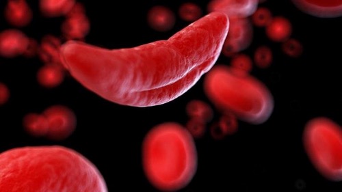 Sickle cell anemia 