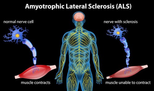 Start of Clinical Trial for the Cell Therapy “CK0803” in Patients with ALS (Amyotrophic Lateral Sclerosis)